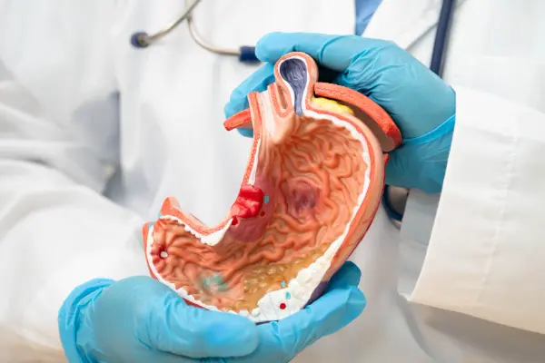 El cáncer gástrico es una enfermedad silenciosa que puede avanzar sin síntomas evidentes en sus primeras etapas y entender su diagnóstico oportuno marca la diferencia en el pronóstico. En este...